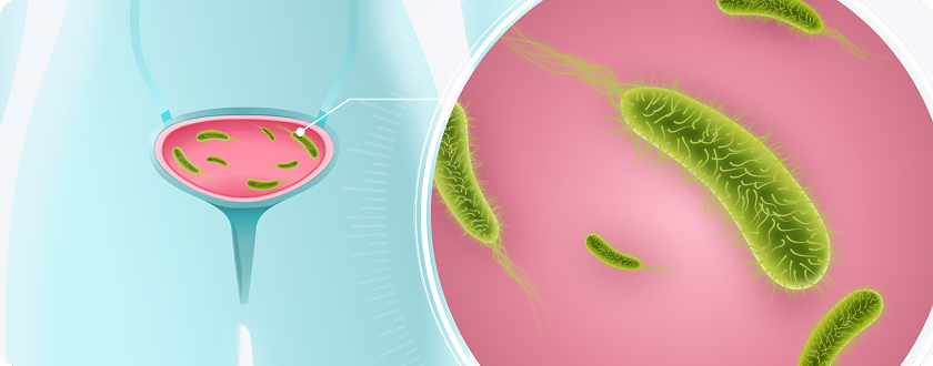 Причины возникновения цистита